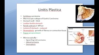 Pathology 521 d Linitis Plastica scirrhous carcinoma stomach leather bottle cancer Signet ring [upl. by Helbonnah]