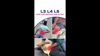 Transform Your Life Say Goodbye to Slipped Disc Pain L3L5  ChiroPhysio Clinic [upl. by Rollecnahc]