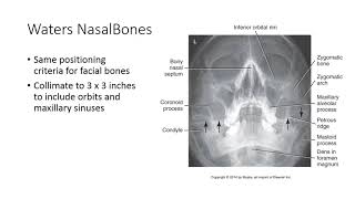 Radiographic Positioning of the Nasal Bones [upl. by Ocram192]