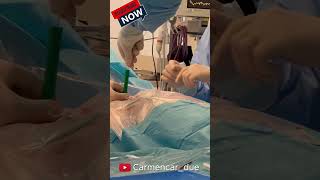 🧣TRAQUEOSTOMÍA PERCUTÁNEA en UCI🧣 enfermería hospital [upl. by Nageem]