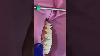 Composite Restoration work dentist dentalcare dentistry dentalhealth shorts [upl. by Ceporah]