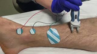 Saphenous Nerve Conduction Studies Proximal and Distal techniques [upl. by Colley391]