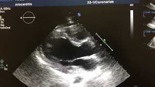 MIOCARDITIS CON DEVERO DAÑO MIOCARDICO FALLA DEL VI Y MUERTE DIAGNOSTICO ECOCARDIOGRAFICO [upl. by Uriah]