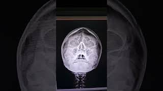 PNS XRAYparanasal sinusPNS Headdoctor Head anatomy nasal septum is deviated to right side [upl. by Nylidnarb]