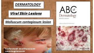 DERMATOLOGY Viral skin lesions  molluscum contagiosum lesions derma lesion viral [upl. by Sellma940]