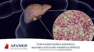 Esteatosis hepática asociada a disfunción metabólica MASLD NAFLD [upl. by Rebm]