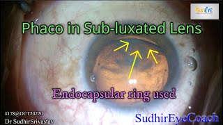 Phacoemulsification in Traumatic Subluxated lens with Endocapsular Ring CTR [upl. by Ettenirt728]