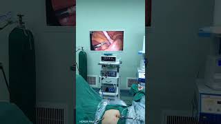 Laparoscopic appendectomy [upl. by Ayotna]