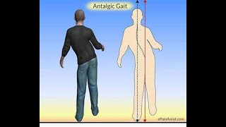 Antalgic Gait  Definition causes characteristics Disease association Diagnosis Treatment [upl. by Tezil]