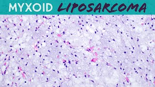 Myxoid Liposarcoma explained in 5 minutes basic soft tissue pathology sarcoma pathologists [upl. by Trautman932]