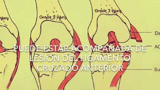 Inestabilidad MEDIAL de rodilla Diagnóstico juancalbornoz ligamentocolateralmedial ligamento [upl. by Ennadroj]