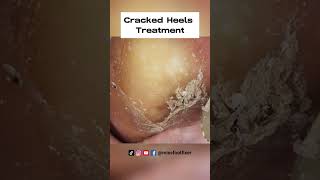 Cracked Heels Treatment Achieve Soft and Supple Feet by famous Foot Doctor Miss Foot Fixer [upl. by Lachman194]