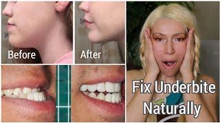 How To Fix An Underbite Naturally  Correcting Protruding Jaw and Chin  Jaw Exercises [upl. by Luella272]