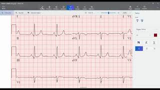 Insuficiencia Cardíaca Congestiva Diagnóstico y Lectura ECG [upl. by Gnahk]