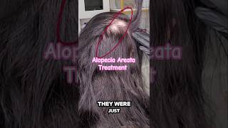 Treatment for Alopecia Areata Houston Hair Loss Options alopecia hairlosstreatment houston [upl. by Inva]