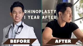 MY RHINOPLASTY amp CHIN AUGMENTATION JOURNEY  Dr Henry Claravall amp Dr Romeo Bato [upl. by Justina]