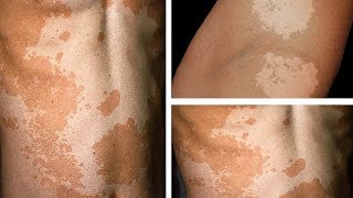 How to Get Rid of Tinea Versicolor Permanently  8 Home Remedies for Tinea Versicolor On BackFace [upl. by Honniball]