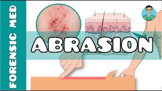 Abrasion  What are the causes of abrasion  What are types of abrasion [upl. by Maggs]