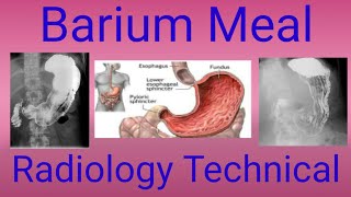 Barium Meal Procedure  upper GI series Complete Examination  By BL Kumawat [upl. by Onstad]