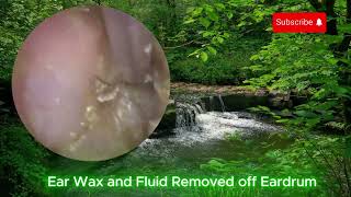 Jobson Horne Endoscopic Ear Wax Removal EAR CLEANING [upl. by Nodearb535]