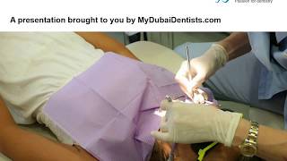 Subgingival Curettage in Dubai [upl. by Arand936]