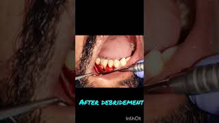 Perio Furcation defect Bone Grafting Saving natural tooth [upl. by Germin916]