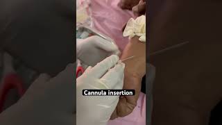 Cannula insertion 👍 shorts hospital cannula injection trending aiims doctor [upl. by Ahsilif688]