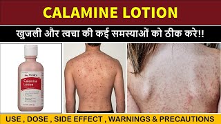 calamine lotion uses  खुजली के लिए बेस्ट लोशन  itching  scabies etc [upl. by Enajiram]