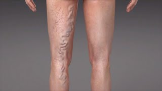 What are Varicose Veins [upl. by Alarick]