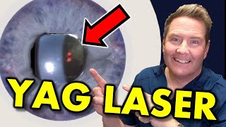 YAG Capsulotomy Laser Eye Treatment What Is It and How Painful Is It [upl. by Akcinehs]