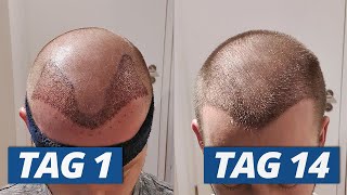 1  14 Tage nach Haartransplantation Der komplette Heilungsverlauf [upl. by Acima920]