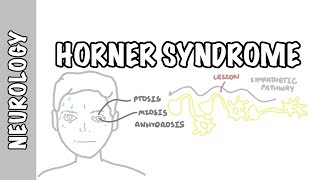 Horner Syndrome  anatomy causes pathophysiology investigation [upl. by Alla487]