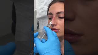 Non Surgical Nose Job with filler nonsurgicalnosejob nosefiller nosejobs [upl. by Randie]