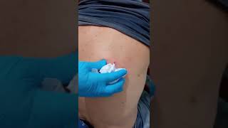 Sebaceous cyst removal rimozione cisti sebacea [upl. by Sigismund]