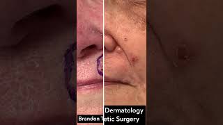 Basal Cell Carcinoma Tumor Before amp After  St Louis Dermatology amp Cosmetic Surgery [upl. by Ruddy789]