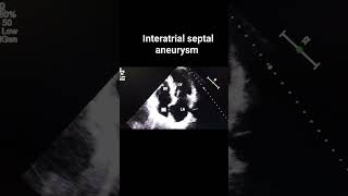 Interatrial septal aneurysm [upl. by Idnek]