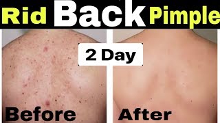 How to Remove Back Acne and PimplesGet Rid of Back amp Body Acne PimpleBack acne treatment [upl. by Quintin42]