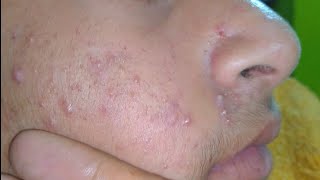 sac be spa blackheads elderly 2024  sac be spa old age blackheads 2024  sac be spa thuy 644 [upl. by Campagna]