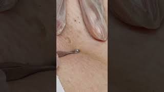 Effective Ingrown Hair Removal  Watch the Transformation [upl. by Uon]