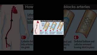 PCI Percutaneous Coronary intervention [upl. by Janus488]