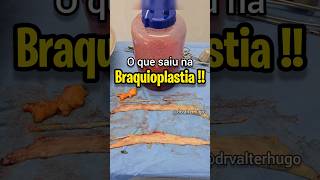 ISSO SAIU NA BRAQUIOPLASTIA cirurgiadebraços lipodebraco braquioplastia drvalterhugo [upl. by Idaf840]