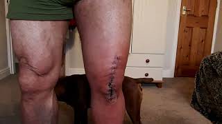 Total Knee Replacement Two Weeks Post OP [upl. by Talbot]