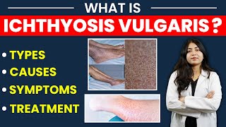 what is Ichthyosis vulgaris  Types causes symptoms amp treatment  रूखी सूखी  फटी हुई त्वचा [upl. by Ielirol]