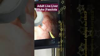 Adult Live Liver Fluke Fasciola found during ERCP [upl. by Euseibbob]