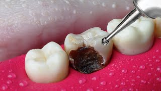 ASMR Restoration Incredible Tooth Cavity And The Master Dentist [upl. by Lallage616]