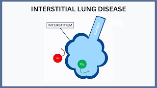 Interstitial Lung Disease Explained [upl. by Oric]