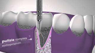 Currettage  Cliniche Dentali Dentix [upl. by Odlawso]