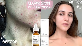 The Ordinary skincare CLEARED MY FACE for good ACNE OUT skincare update [upl. by Noid923]