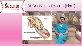 DeQuervains Disease का इलाज़ Hindi India [upl. by Ayim]