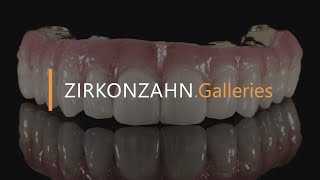 Prettau® 4 Anterior® zirconia on Sintermetall  ZirkonzahnGalleries [upl. by Ecirtac]